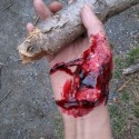 handinjury